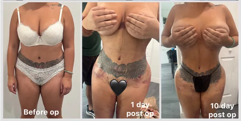 Client front photos labeled before op, 1 day post op and 10 day post op